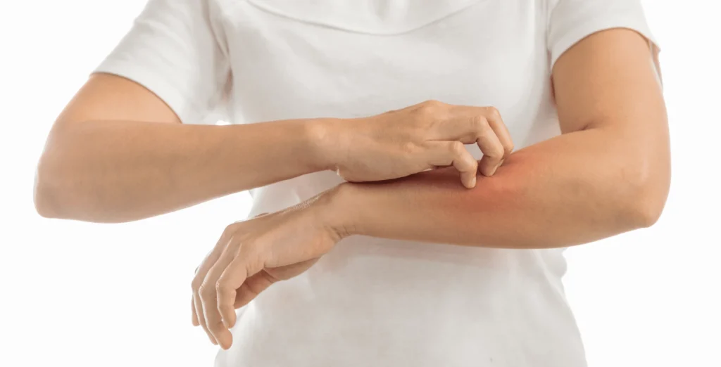 Psoriasis Treatment