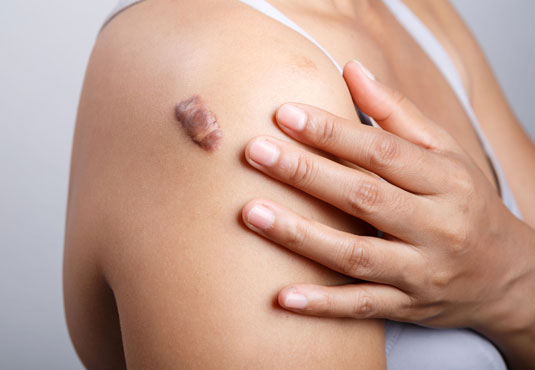 Keloid Tedavisi