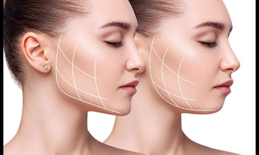 Masseter Botoks