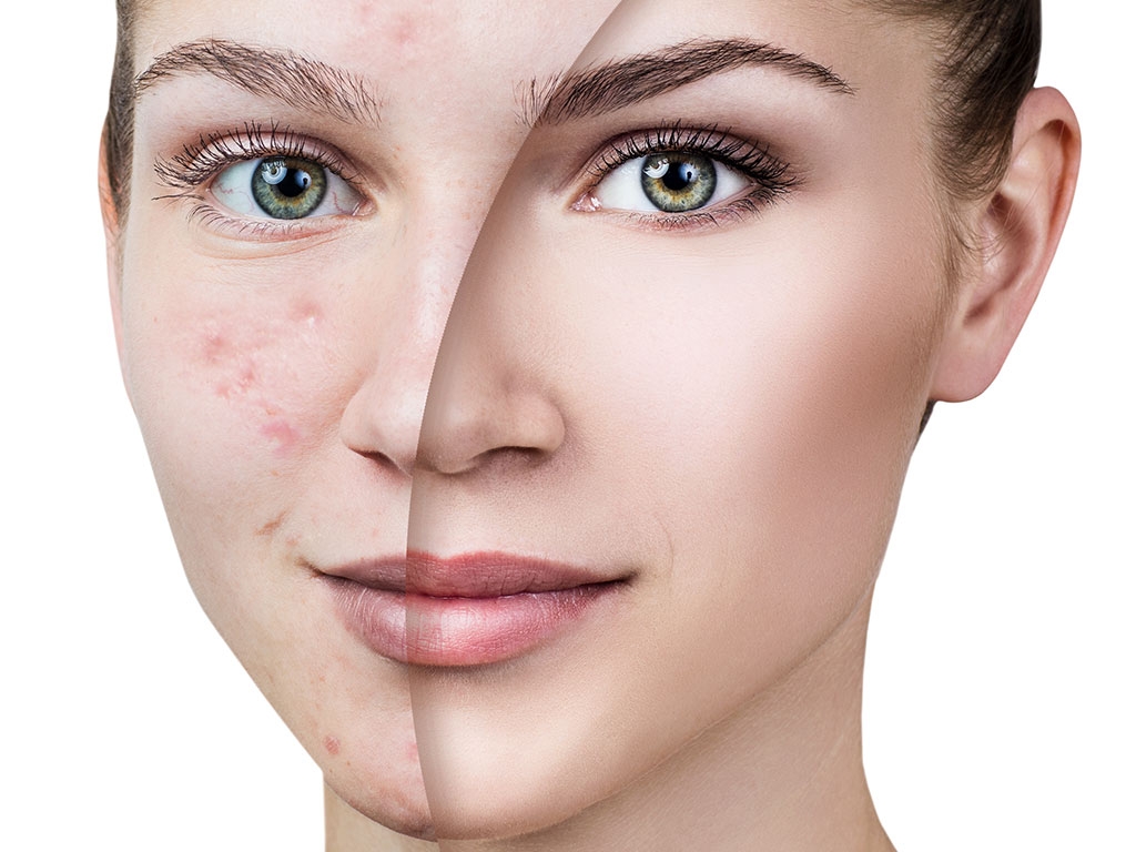 Melasma Tedavisi