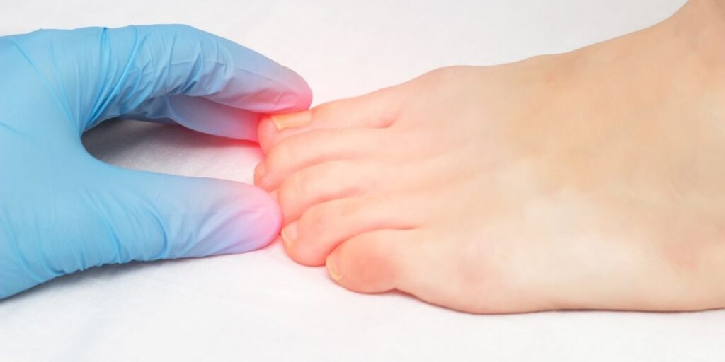 Nail Fungus Treatment