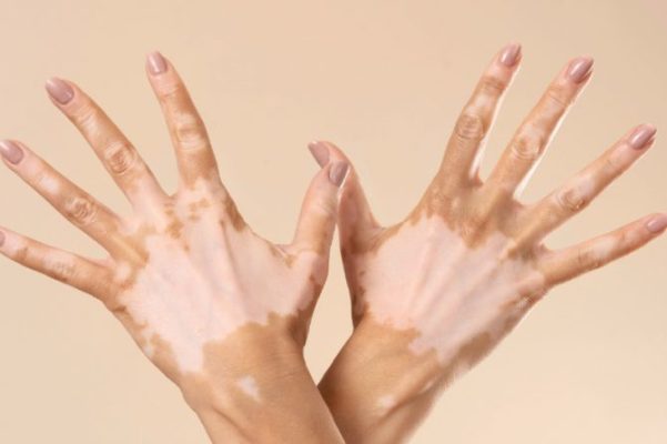 Vitiligo Tedavisi