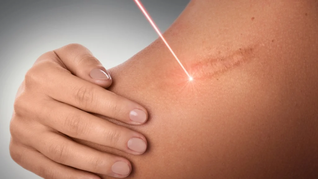 Burn Scar Treatment