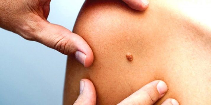 hpv tedavisi 714x357 1