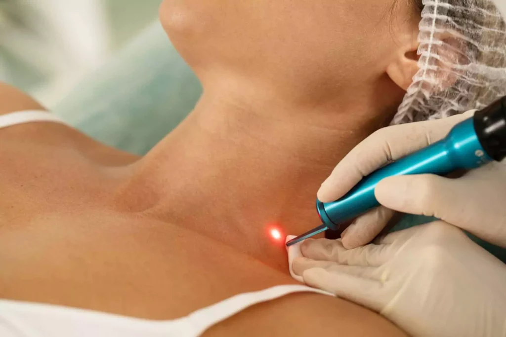Pulsed Dye Lazer